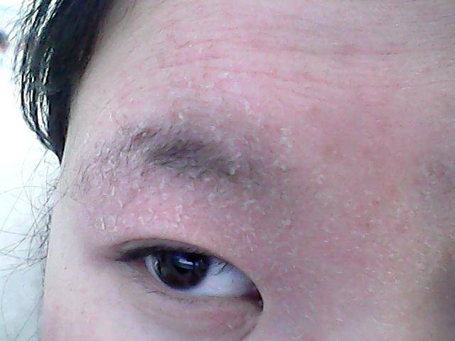 揭密脸上起皮五大原因 四招缓解皮肤干燥