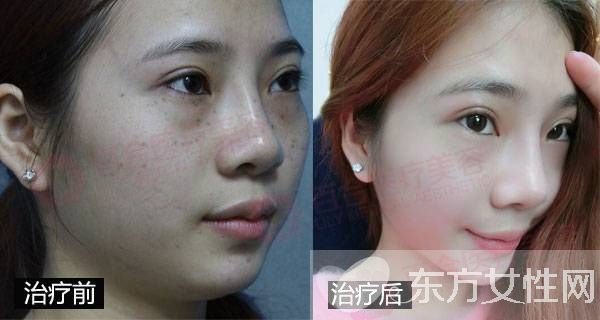 激光祛斑好不好 怎样祛斑最有效