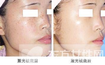 激光祛斑好不好 怎样祛斑最有效