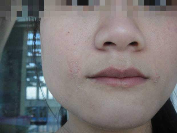 揭密脸上起皮五大原因 四招缓解皮肤干燥