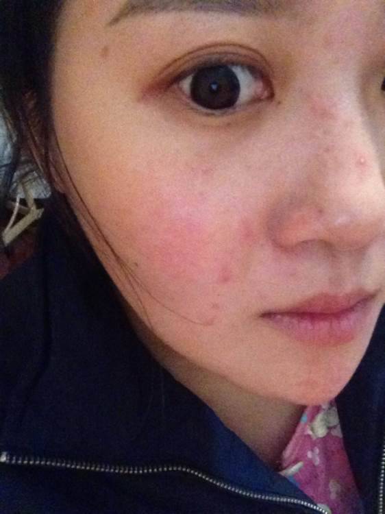 揭右脸长痘痘原因 三小妙招还你白嫩肌肤