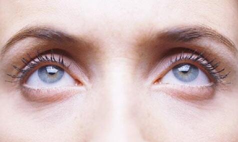 眼袋大怎么办呢 专家教你该如何去除大眼袋