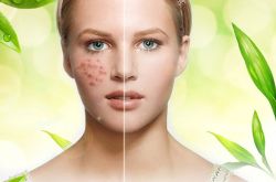 痘坑修复水能快速的解决痘印问题 是真的吗