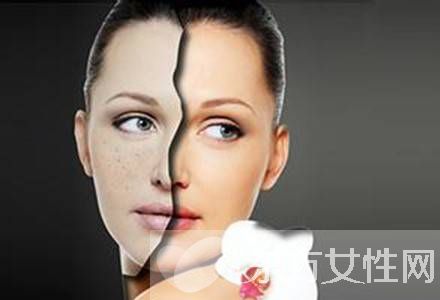 激光祛斑好不好 怎样祛斑最有效