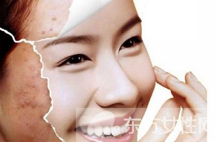 祛痘小妙招 只留青春不留痘