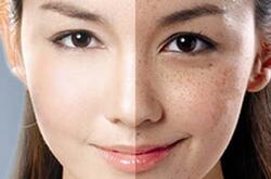 怎么样去除色斑 去除色斑的六大神奇小妙招