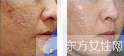 怎么样去痘疤 痘疤和痘印的区别