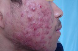 6个引起痤疮粉刺的原因 治疗痤疮粉刺偏方推荐