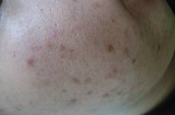 怎么样去痘疤 痘疤和痘印的区别