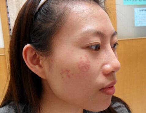 脸颊两侧长斑的原因 2个小窍门教你如何祛斑