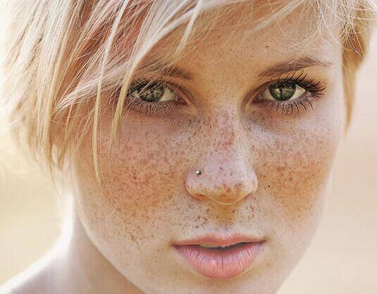 脸颊两侧长斑的原因 2个小窍门教你如何祛斑