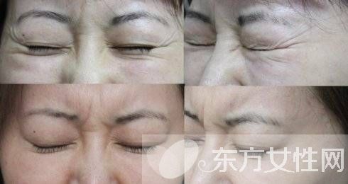 怎样消除眉间皱纹 四大方法任你选择