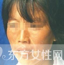 如何有效去除色斑黄褐斑
