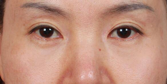 眼部皱纹怎么去除 五种人容易长皱纹