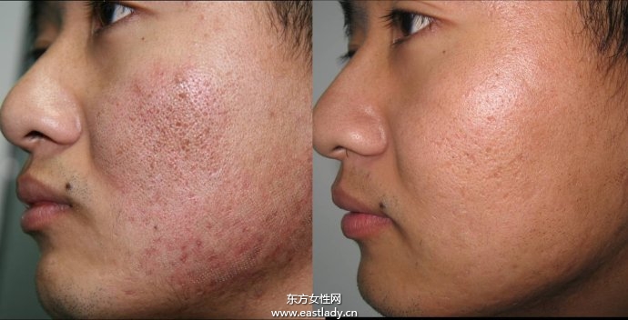 五个简单小妙招 让你跟青春痘疤痕say goodbye