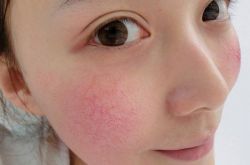 用什么可以去红血丝 这么做可以快速去除红血丝哦