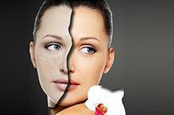 激光祛斑好不好 怎样祛斑最有效