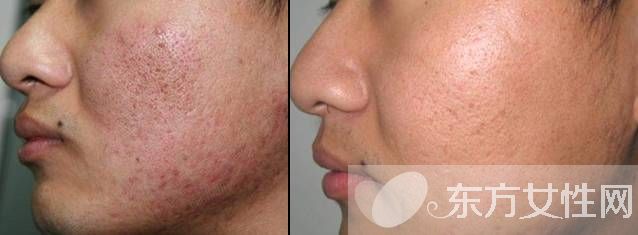怎么样去痘疤 痘疤和痘印的区别