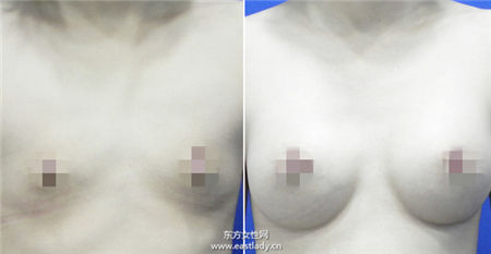 内视镜隆乳平胸女孩的福音