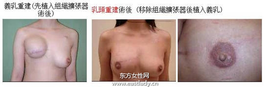 乳腺癌患者乳房重建 重塑女人魅力
