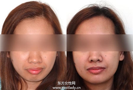 暴牙可以矫正吗 矫正后可以瘦脸吗