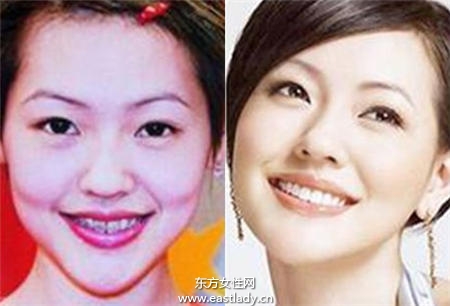 暴牙可以矫正吗 矫正后可以瘦脸吗