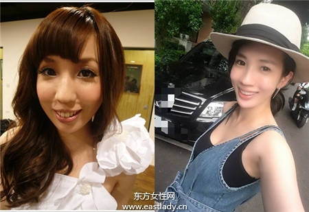 整容手术以改善咬合不正下颚突出 明星也这样做