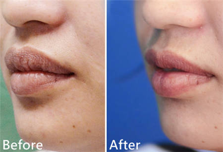 厚唇改薄 打造女明星完美微笑
