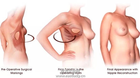 乳腺癌患者乳房重建 重塑女人魅力