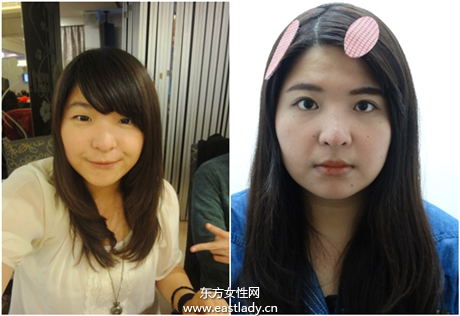 双眼皮该缝还是该割 要根据眼型来选择