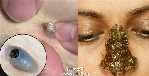 黑头粉刺千万不能挤 这样去黑头 让你摆脱 草莓鼻