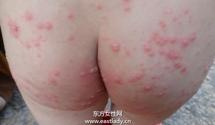 注意预防皮肤过敏