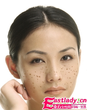 不同部位长斑的原因