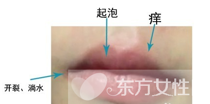 嘴上起泡是什么原因 该怎么治疗