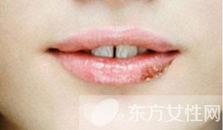 嘴上起泡是什么原因 该怎么治疗