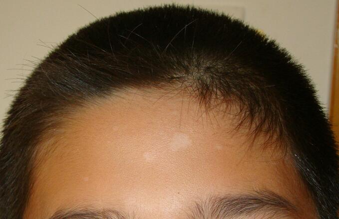 白色糠疹是什么 白色糠疹的病发原因是什么