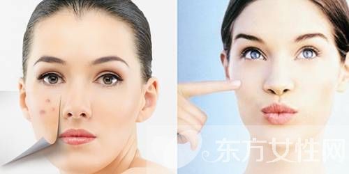 青春痘的治疗小偏方 7个偏方帮你解决面子问题