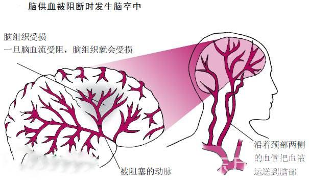 什么是脑卒中 这些细微的表现居然是它的早期症状