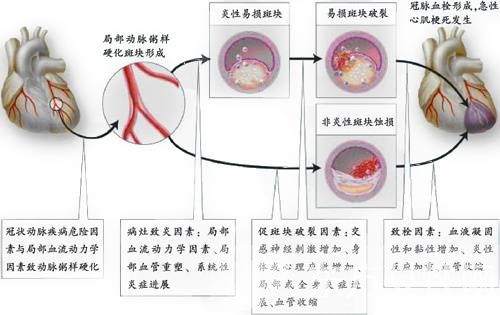 心肌缺血症状有哪些 注意休息和饮食最重要