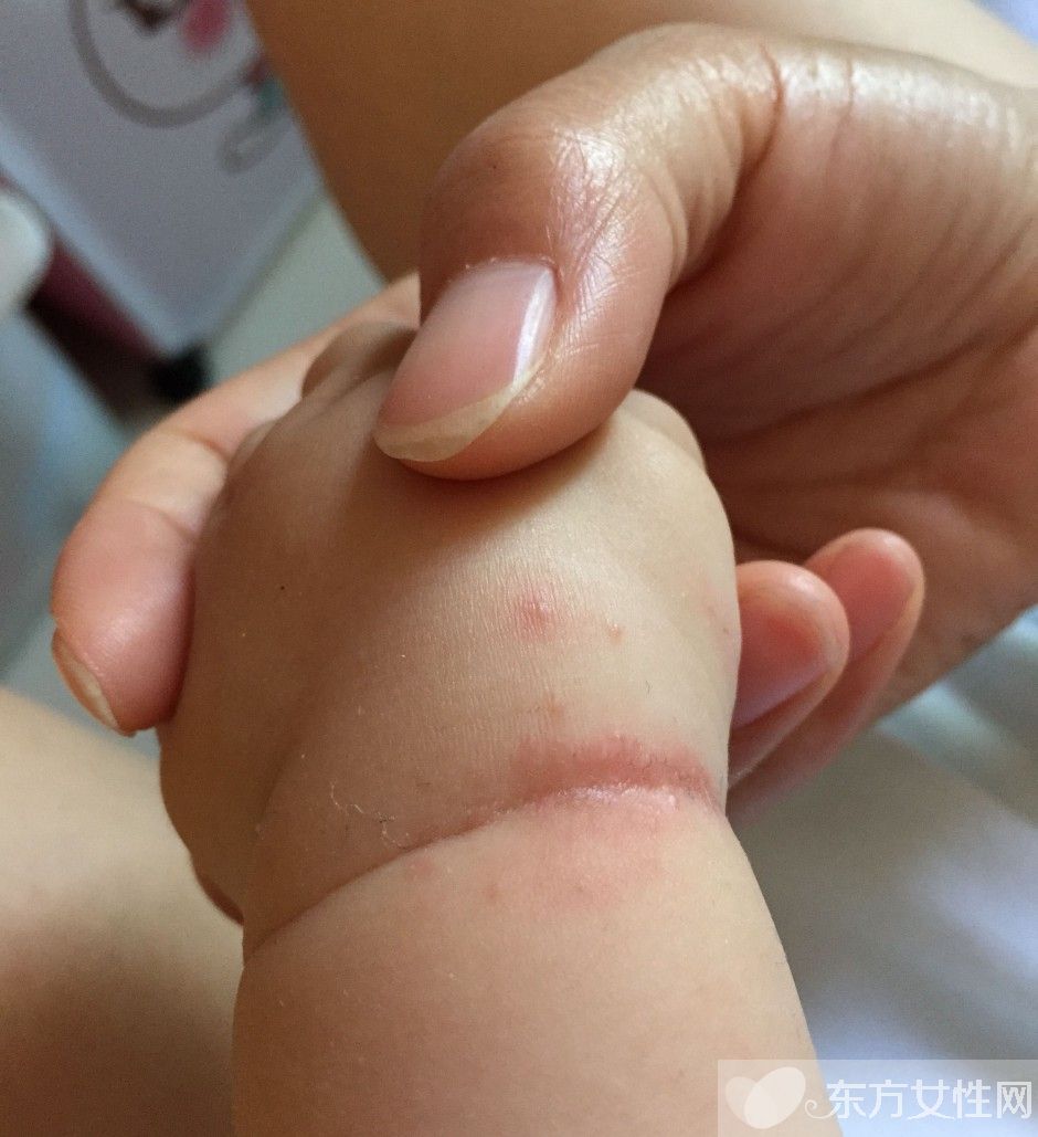 湿疹会传染吗 一些你不知道的治疗湿疹小偏方推荐