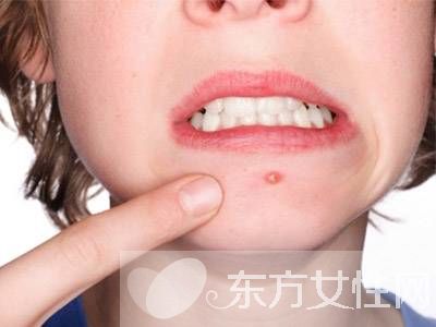 青春痘的治疗小偏方 7个偏方帮你解决面子问题