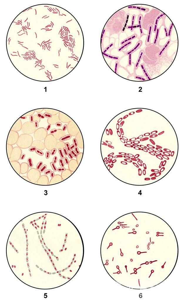结核性脑膜炎会传染吗 脑膜炎的传染途径