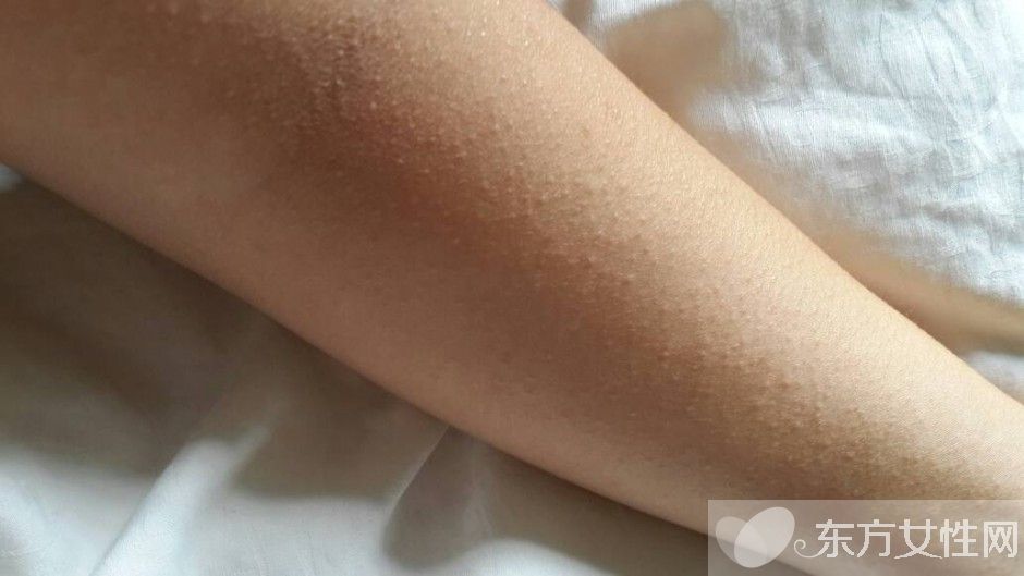 湿疹会传染吗 一些你不知道的治疗湿疹小偏方推荐