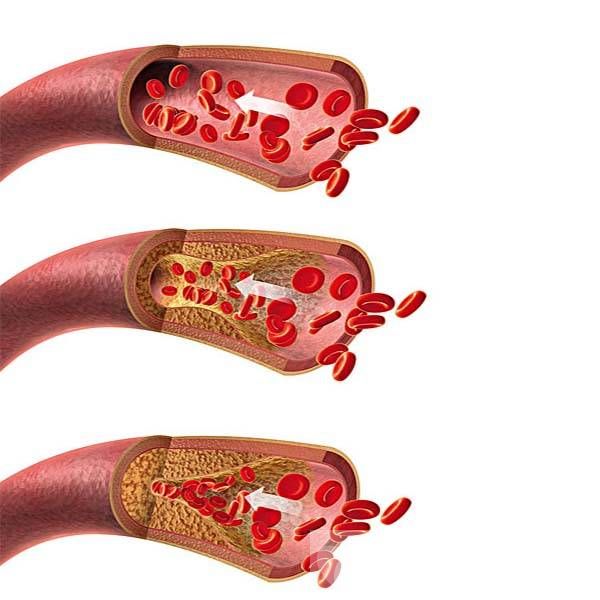 动脉硬化的症状表现有哪些 防止动脉硬化应多吃这些