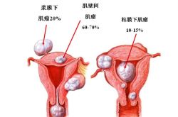 治疗子宫肌瘤的偏方 这些居然是子宫肌瘤的早起症状