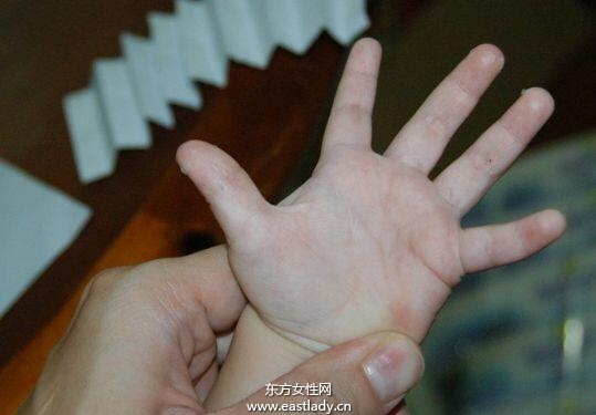 手上脱皮是怎么回事呢 轻松几招让你告别脱皮