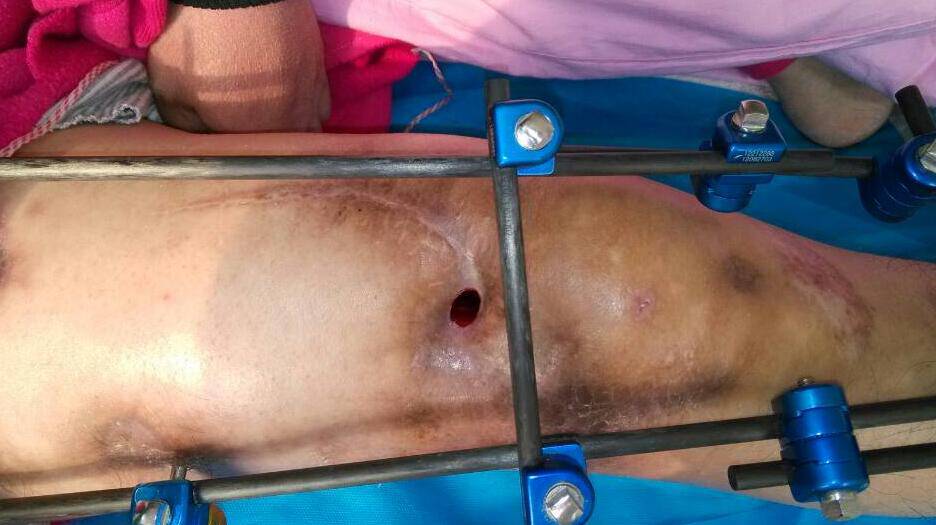 骨髓炎能治好吗 揭秘骨髓炎症状危害