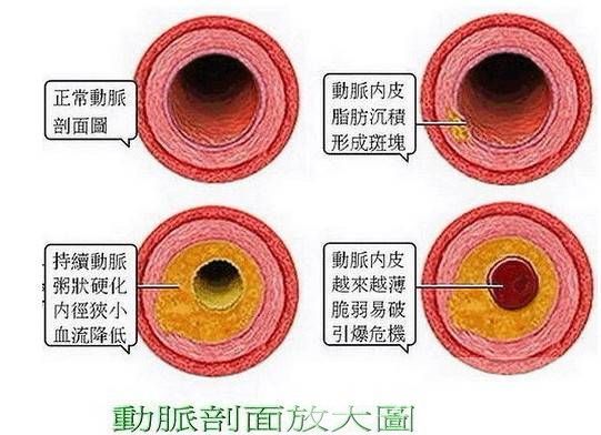 高血脂的治疗与饮食 最见效的食疗方法推荐