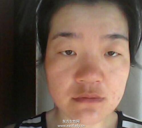 上眼皮突然下垂怎么办 这可能是疾病信号