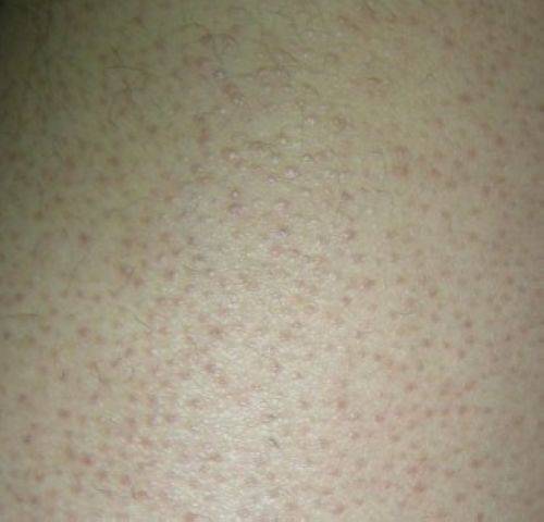 毛周角化是什么 揭你所不知的 鸡皮肤 治疗